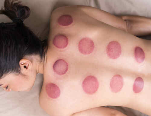 Curious about cupping therapy? These are the benefits.